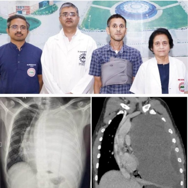 ऋषिकेश एम्स में 3.25 किलो के फेफड़े के ट्यूमर का