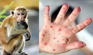 Monkeypox को लेकर उत्तराखंड में अलर्ट, स्वास्थ्य विभाग ने बताये