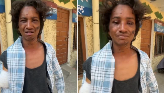 छोटे भाई के दोनों हाथ कटवाने के आरोप में भाई-भाभी